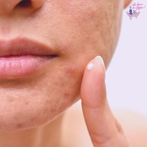 Les solutions naturelles pour lutter contre l'acné à la ménopause