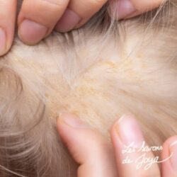 Dermatite séborrhéique du cuir chevelu : comprendre, apaiser et prendre soin naturellement