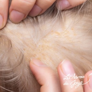 Dermatite séborrhéique du cuir chevelu : comprendre, apaiser et prendre soin naturellement