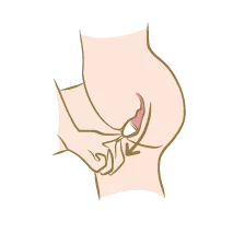 Un retrait facilité : Pour retirer votre coupe menstruelle il suffit de tirer doucement sur la tige jusqu'à ce que vous attrapiez la base de ce dispositif. Un embout est prévu pour faciliter la préhension lors du retrait.Pincez-la et bougez-la jusqu'à pouvoir la retirer délicatement.Lorsque votre coupe est retirée, videz le flux dans les toilettes et rincez-la à l'eau tiède ou avec un savon bio spécifique pour toilette intime.